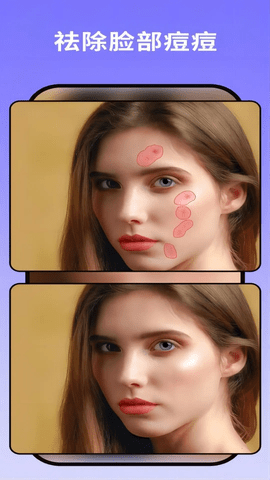 Retouch AI:Pimple Remover